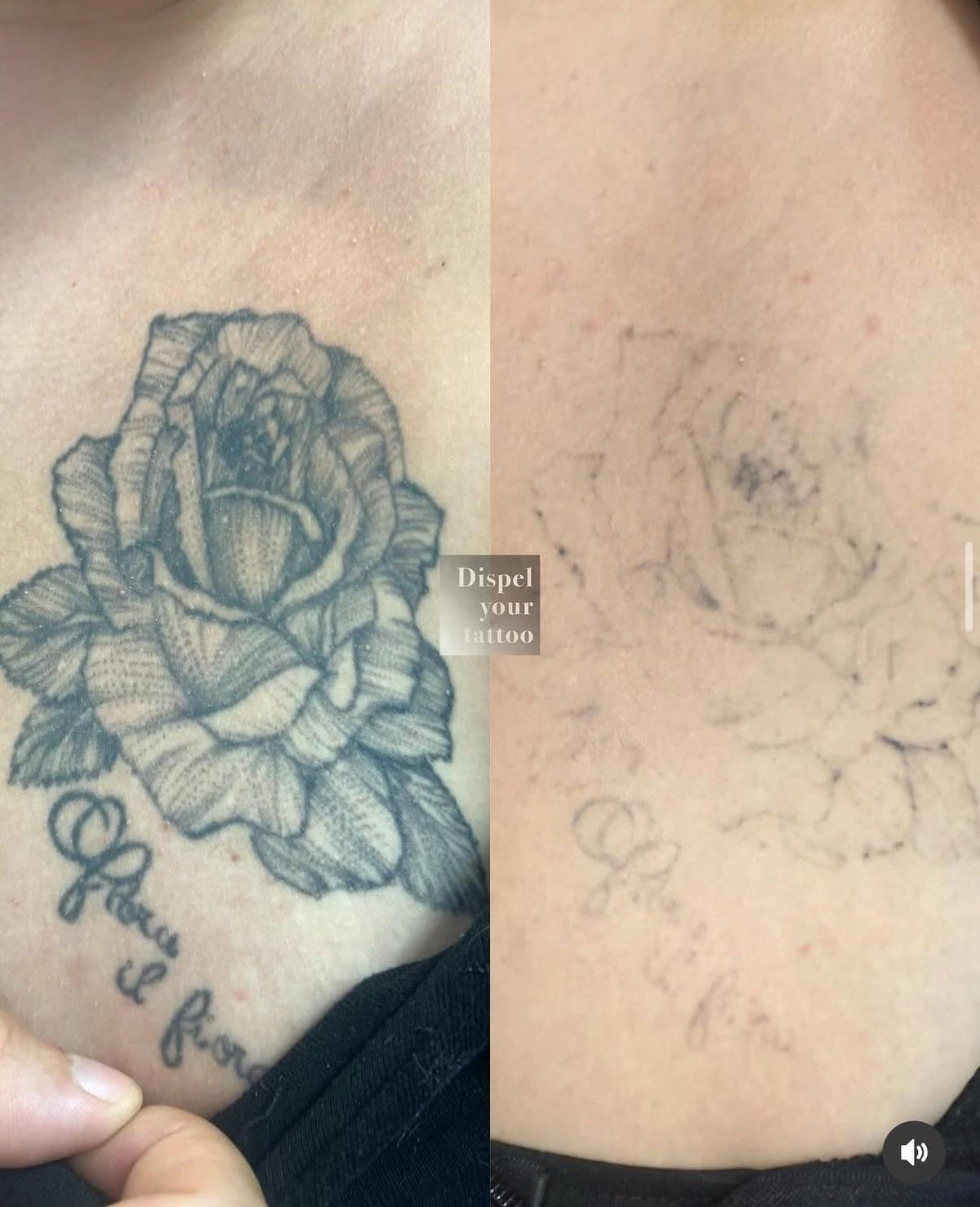 NEATCELL— Fade Tattoos & Dark Spots at Home