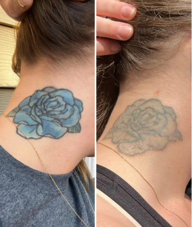 NEATCELL— Fade Tattoos & Dark Spots at Home