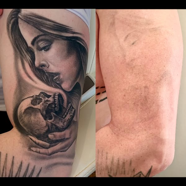 Tattoo removal information and device visuals